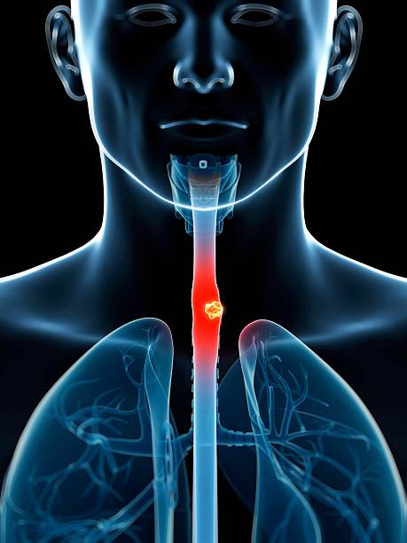 What You Should Know about throat cancer