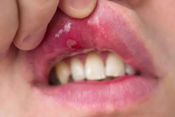 Common Signs And Symptoms of Canker Sore