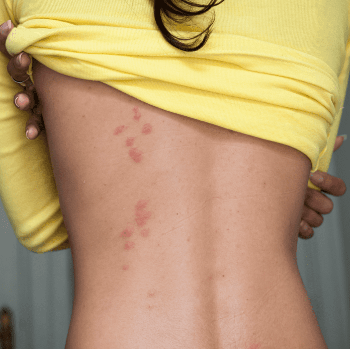 Bed Bugs Bite: What Are They And Treatments